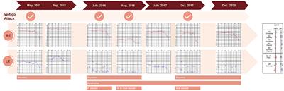 Case Report: Ménière's Disease-Like Symptoms in 22q11.2 Deletion Syndrome